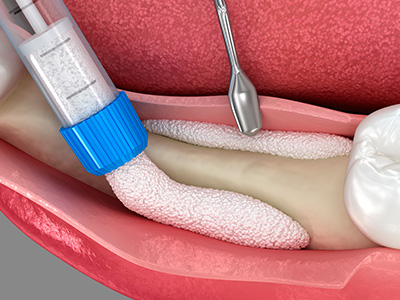 The image shows a close-up view of an open mouth with a medical device inserted into it, attached to a syringe, and surrounded by various medical equipment such as gauze and a surgical sponge.