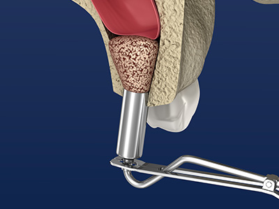 The image shows a medical illustration of an endoscopic procedure being performed on a tooth, with a device inserted into the mouth through a small incision in the gum.