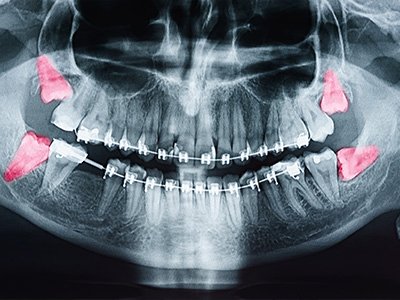 The image shows a medical X-ray film with an overlay of a skull and teeth, highlighting areas of interest with red dots, possibly indicating areas of concern for dental or orthodontic treatment.